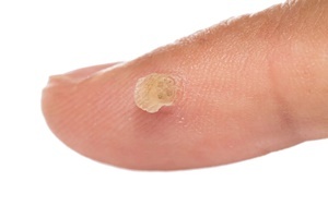Warts - a skin disease which effective in fighting the Skincell Pro
