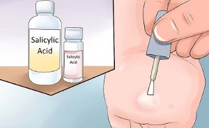 How to get rid of papilloma using folk methods